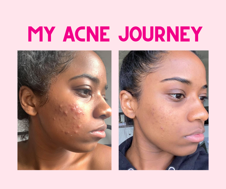 Tretinoin cream for acne deals